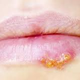 Illustration for article titled Obat Penyakit Herpes Di Mata